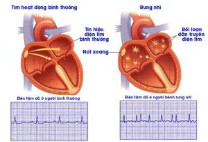 Những tác nhân gây rung nhĩ là gì?