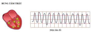 Rung nhĩ (AFib) và rung thất (VFib): triệu chứng, chẩn đoán và điều trị