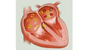 Rung nhĩ: Hiệu quả của phương pháp phẫu thuật Maze