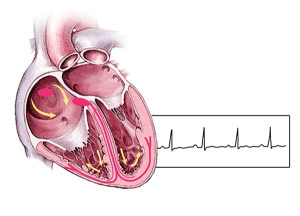 Rối loạn nhịp thất là gì và điều trị bằng cách nào?