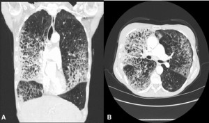 Chụp cắt lớp vi tính (Chụp CT) giúp phát hiện thuyên tắc phổi như thế nào?