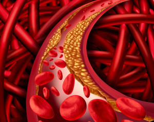 Nguyên nhân gây mức triglyceride cao, HDL thấp hoặc LDL cao