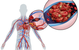 Hút thuốc có gây thuyên tắc phổi không?