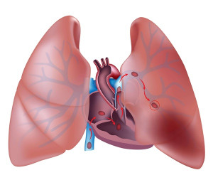 Thuyên tắc phổi (cục máu đông trong phổi): Nguyên nhân, triệu chứng và cách phòng ngừa