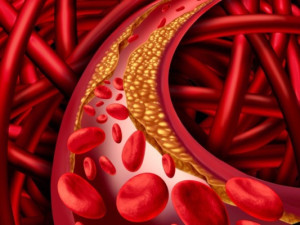 Tăng lipid máu có gây ra triệu chứng không?