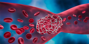 Có những loại huyết khối nào?