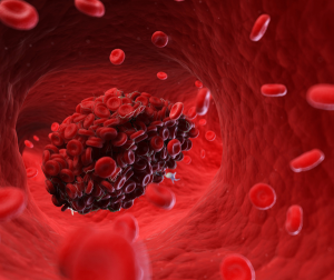 Các dấu hiệu nhận biết cục máu đông