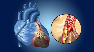Huyết khối động mạch vành: Phương pháp điều trị và tiên lượng