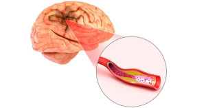 Triệu chứng và cách điều trị huyết khối tĩnh mạch não