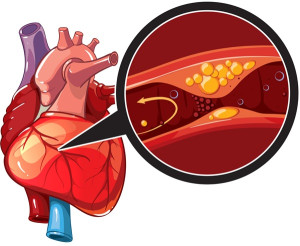 Bệnh động mạch vành đa nhánh là gì?