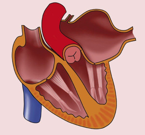 Phì đại nhĩ trái: Triệu chứng và cách điều trị
