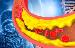 Tăng lipid máu: Nguyên nhân, triệu chứng và cách điều trị