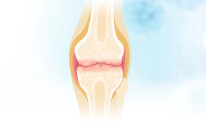 Thoái hóa khớp: Nguyên nhân, triệu chứng và điều trị