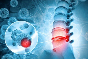Ung thư di căn xương điều trị bằng cách nào?