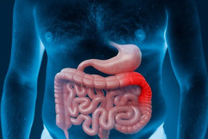 Viêm loét đại tràng: Triệu chứng, nguyên nhân và cách điều trị