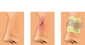 Gãy xương mũi điều trị bằng cách nào?