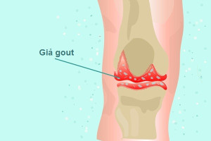 Bệnh giả gout là gì?