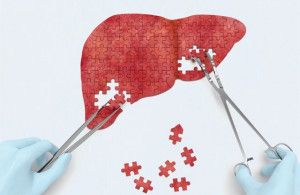 Sau ghép gan sống thêm được bao lâu?