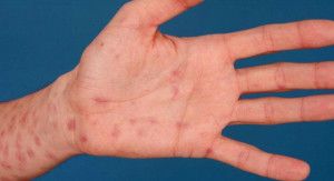 Giang mai thứ phát điều trị bằng cách nào?