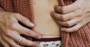 Lạc nội mạc tử cung sau sinh mổ