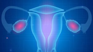 Các loại ung thư buồng trứng hiếm gặp