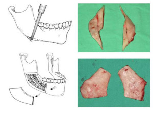 Lateral cortex ostectomy - cắt bản ngoài xương