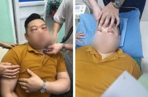 Sốc phản vệ do thái 1 củ hành, nam thanh niên ở Phú Thọ nguy kịch