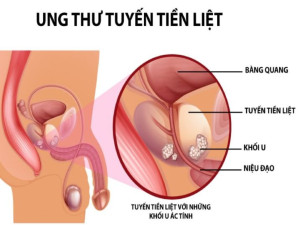 Ung thư tuyến tiền liệt - những câu hỏi thường gặp