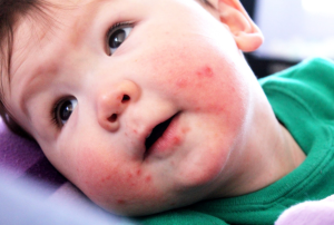 Cách nhận biết trẻ bị nhiễm giun sán