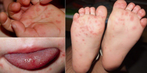 Cách nhận biết trẻ bị nhiễm giun sán