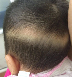 Hướng dẫn cách xử lý cơn hen cấp cho trẻ tại nhà