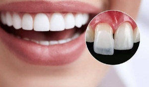 Vì Sao Nên Căng Da Nách? Giải Pháp Cho Làn Da Săn Chắc và Tự Tin Hơn