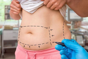 Căng Da Đùi – Giải Pháp Xóa Tan Nỗi Lo Da Chùng Nhão Sau Giảm Cân