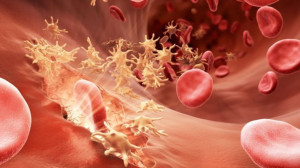 Phân biệt sốt rét và sốt xuất huyết