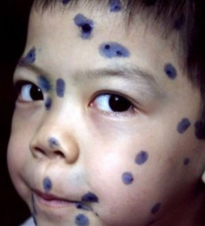 Phân biệt sốt rét và sốt xuất huyết