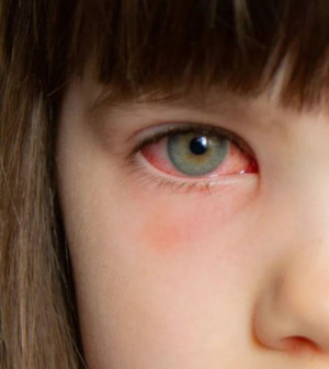 Những lưu ý khi sử dụng thuốc trị đau mắt đỏ