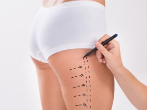 Căng Da Đùi - Bí Quyết Giúp Đôi Chân Thon Gọn Hoàn Hảo