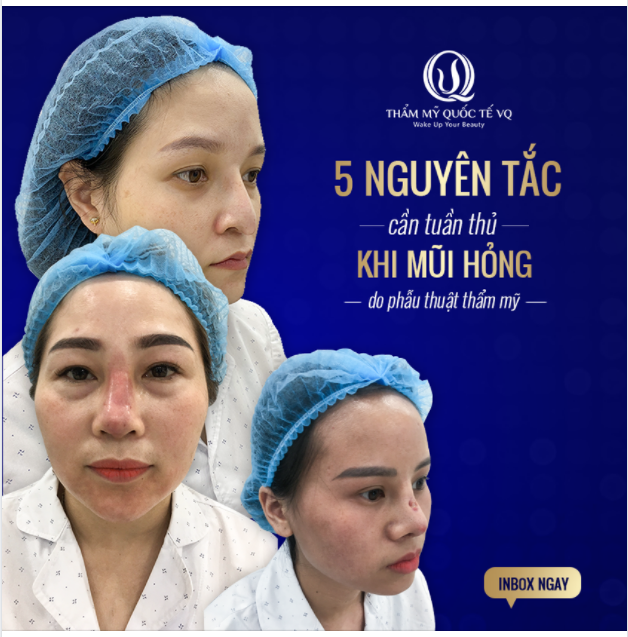 5 nguyên tắc cần tuân thủ khi nâng mũi hỏng do phẫu thuật thẩm mỹ