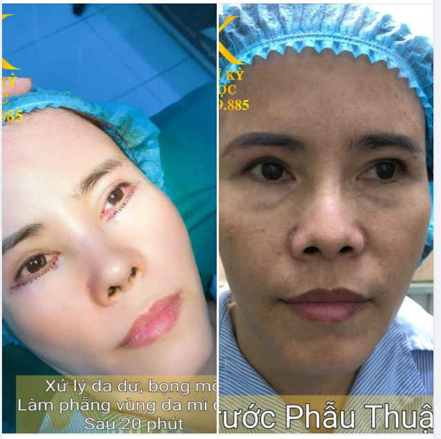 CẮT MẮT MÍ DƯỚI PLASMA
