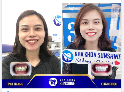 Chị khách hàng chia sẻ: Trước kia mình ngại giao tiếp lắm, mình cũng hạn chế cười suốt ngày đi đâu cũng đeo khẩu trang vì tự ti vì hàm răng khấp khểnh của mình.