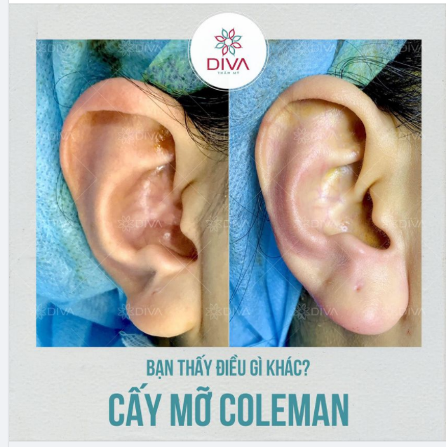 CÓ THỂ TẠO HÌNH DÁI TAI BẰNG NHỮNG PHƯƠNG PHÁP NÀO?