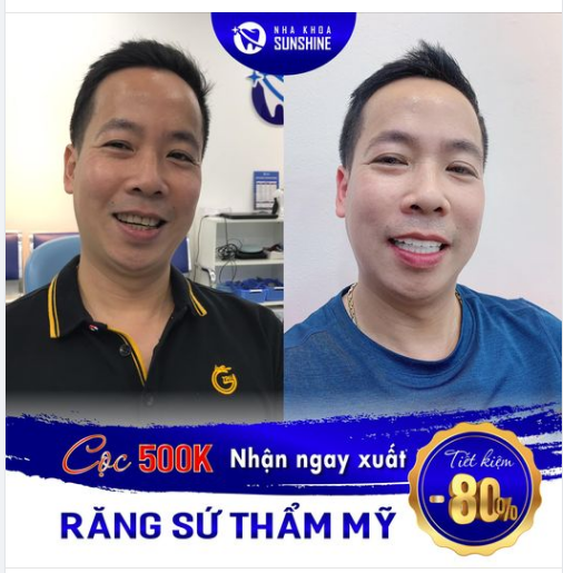 CỌC TRƯỚC 500K NHẬN NGAY GÓI ƯU ĐÃI BỌC RĂNG SỨ THẨM MỸ