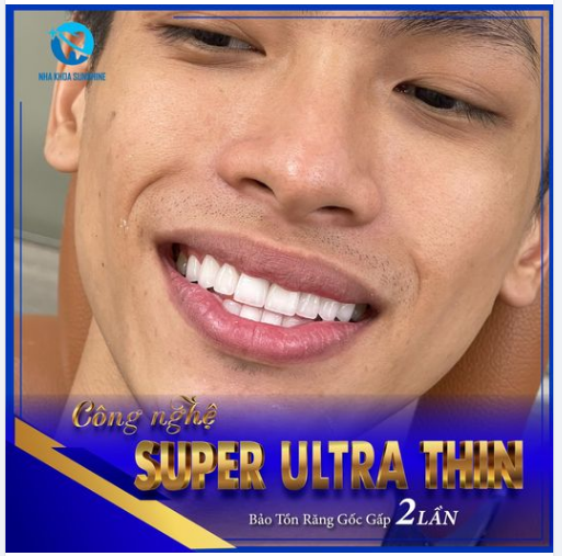 CÔNG NGHỆ SUPER ULTRA THIN – GIẢI PHÁP SỞ HỮU HÀM RĂNG TRẮNG SÁNG CHUẨN TỶ LỆ VÀNG