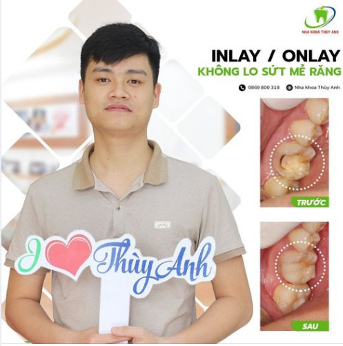 DÁN SỨ INLAY/ONLAY - GIẢI PHÁP BỀN VỮNG TIẾT KIỆM MÔ RĂNG