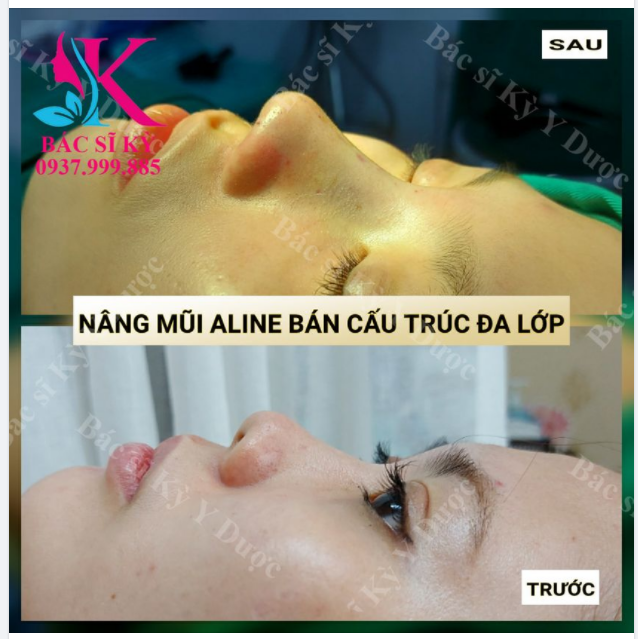DÁNG MŨI ALINE CỰC KÌ XUẤT SẮC