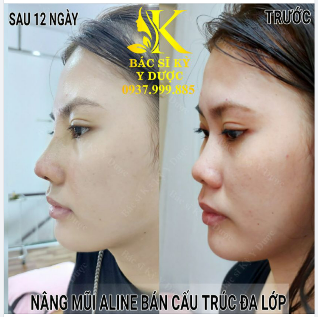 Dáng mũi Aline đẹp xuất thần chỉ sau 12 ngày cho bạn nữ Kiên Giang xa xôi.