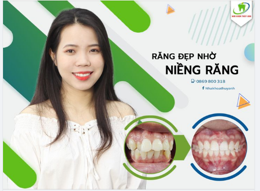 ĐÁNH BAY HÀM RĂNG HÔ, KHẤP KHỂNH VỚI NIỀNG RĂNG