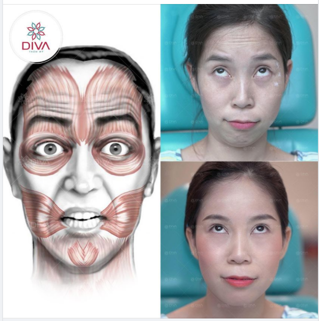 DẤU HIỆU NHẬN BIẾT BẠN NÊN TIÊM BOTOX TRÁN GIẢM NẾP NHĂN