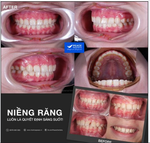 Điều trị khớp cắn sâu bằng phương pháp niềng răng