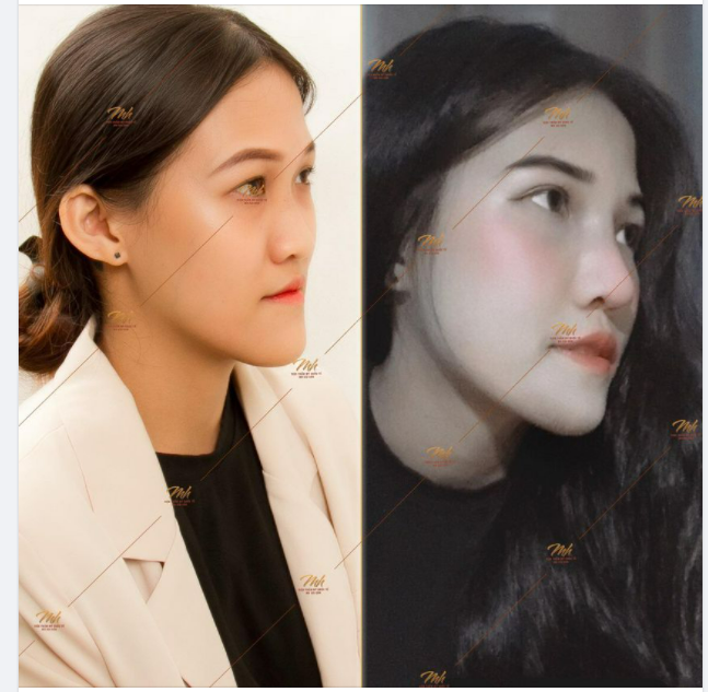 ĐỪNG thấy mũi CAO TỰ NHIÊN mà nghĩ KHÔNG 'HÚT'